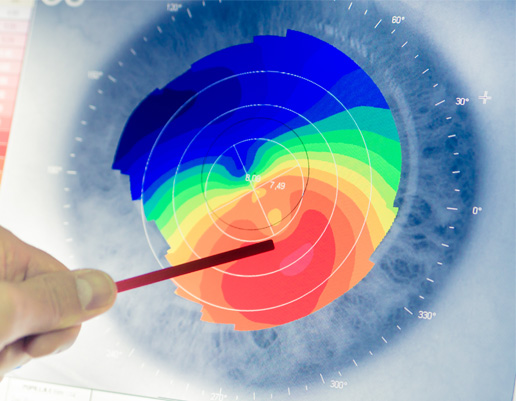 Nahaufnahme eines Auges mit farbiger topografischer Karte der Hornhaut, auf die ein Zeigestab zeigt.