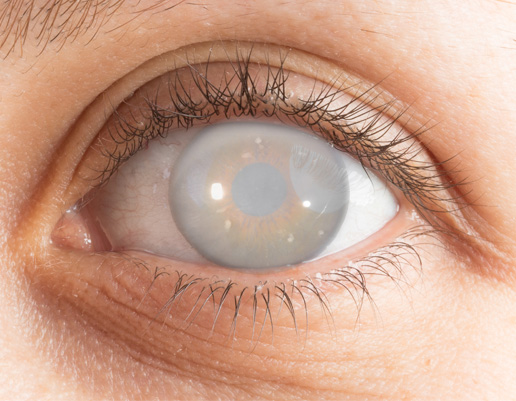 Nahaufnahme eines menschlichen Auges mit trüber, grauer Hornhaut und sichtbaren Wimpern.