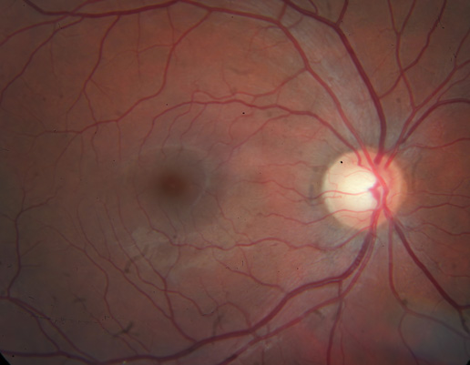 Nahaufnahme der Netzhaut mit sichtbaren Blutgefäßen und hellem Sehnervenkopf rechts
