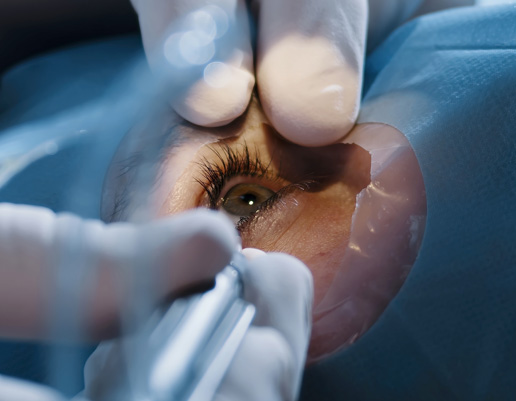 Nahaufnahme eines Auges mit geöffnetem Lid, umgeben von medizinischem Tuch, Hände mit Handschuhen führen ein Instrument am Auge.