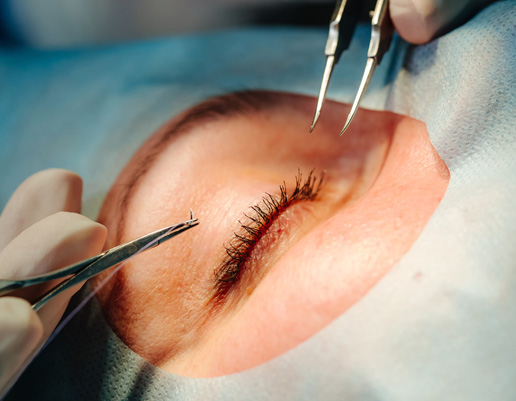 Nahaufnahme eines geschlossenen Auges mit langen Wimpern, umgeben von medizinischem Tuch, Hände mit Pinzetten führen eine Behandlung durch.